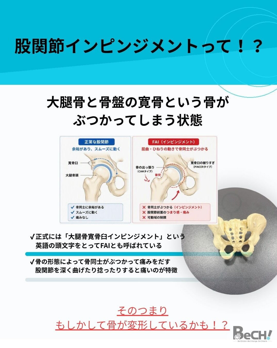 【股関節がつまる人ストレッチでは治らないかも】