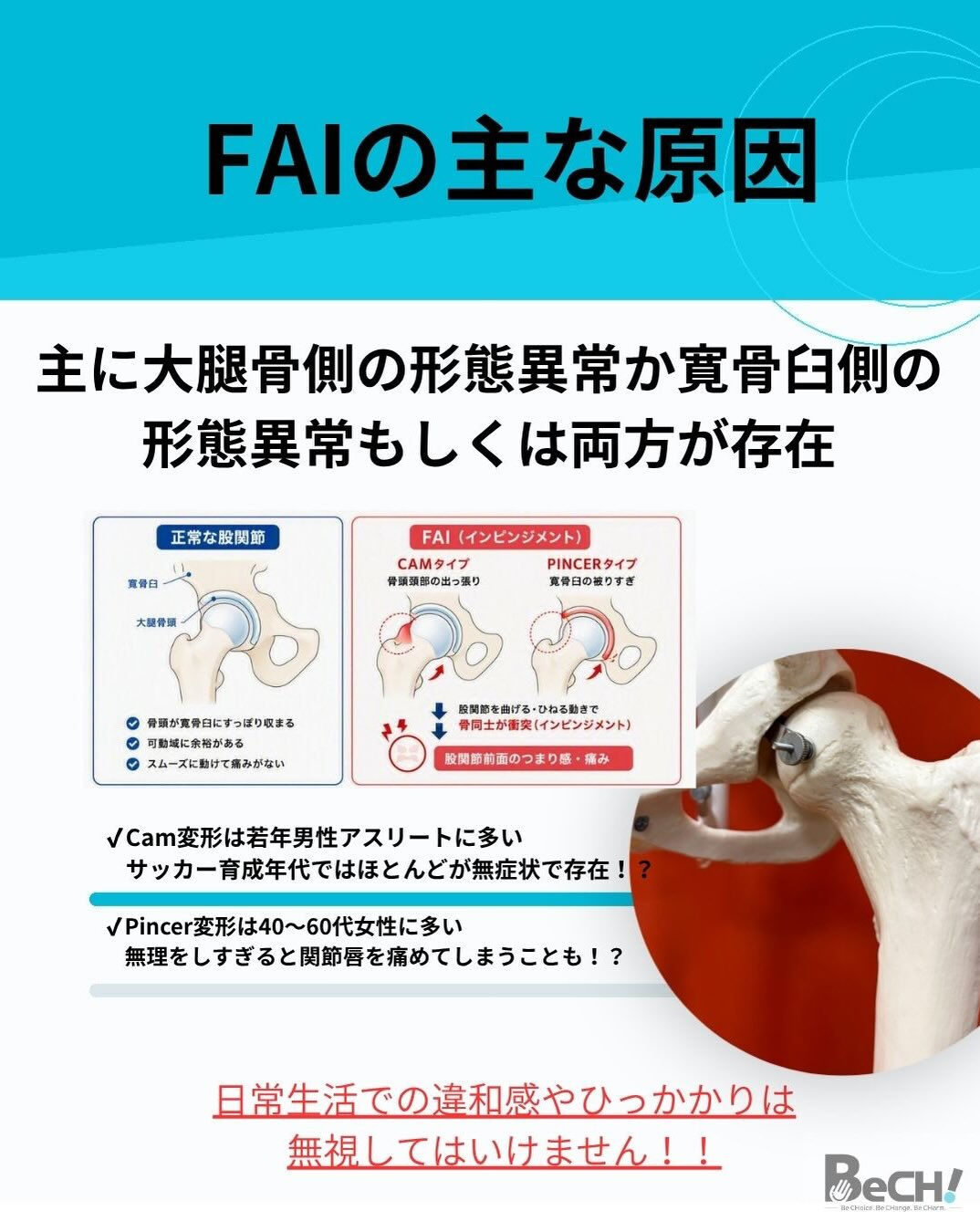 【股関節がつまる人ストレッチでは治らないかも】